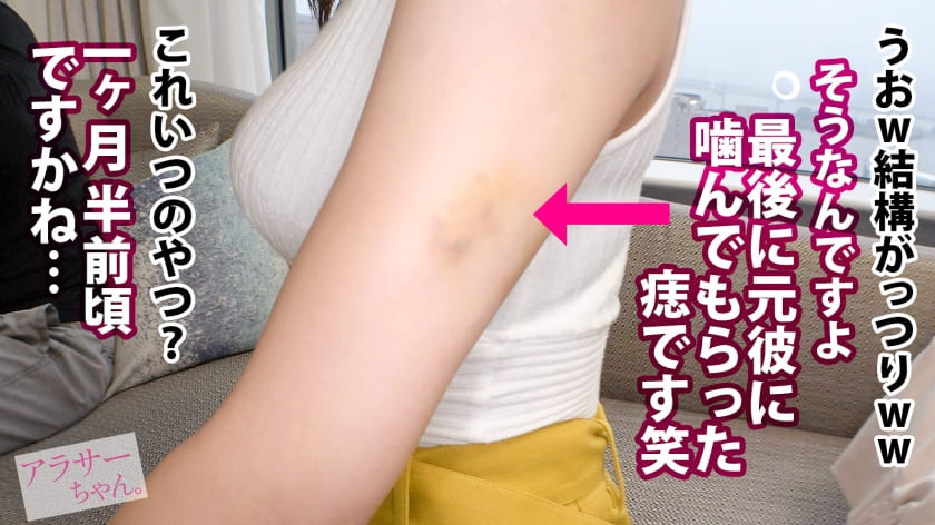 元彼に甘咬みされた痣を見せる都月るいさ（とつきるいさ）さん